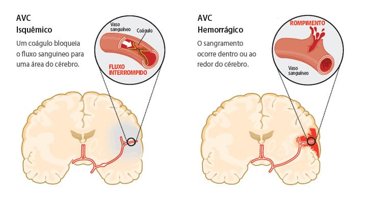 Importância do fonoaudiólogo no tratamento do AVC (acidente vascular cerebral)