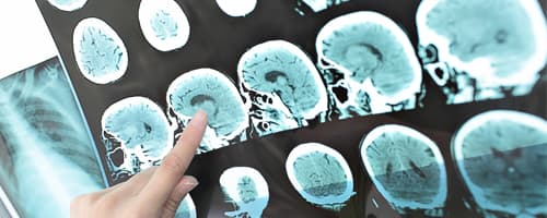 Pacientes que têm esclerose contam com novo medicamento 