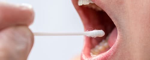 Câncer bucal: HPV está entre os principais fatores de risco da doença