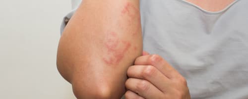 Dermatite de contato: você sabe o que é? 