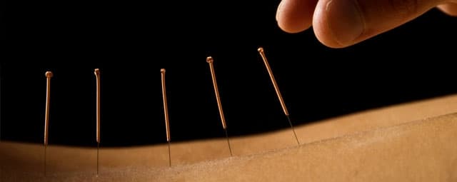 A Acupuntura e suas teorias