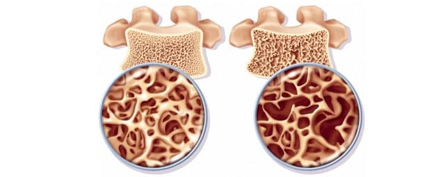 O que é Osteoporose?