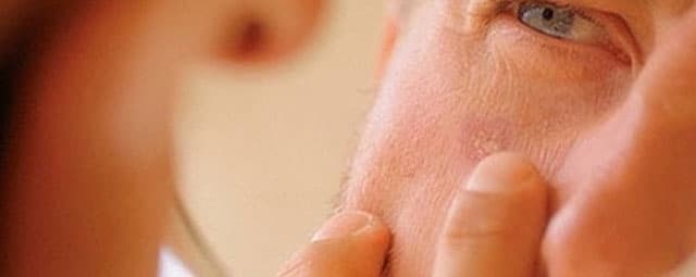 Como prevenir o câncer de pele