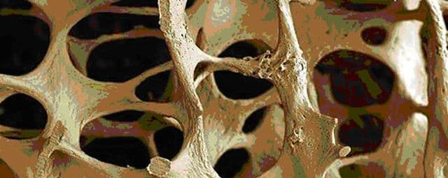 O que é a osteoporose?
