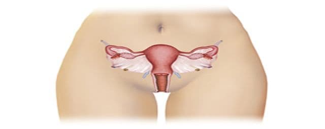 Endometriose